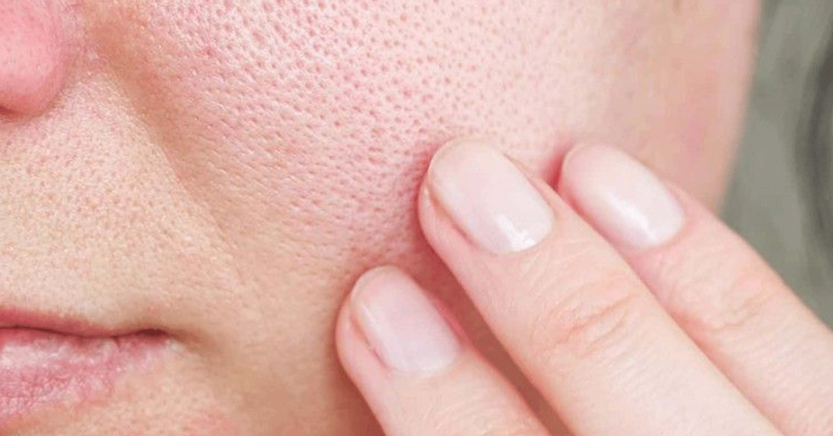 Lỗ Chân Lông To: Nguyên Nhân, Cách Khắc Phục và Giải Pháp Hiệu Quả