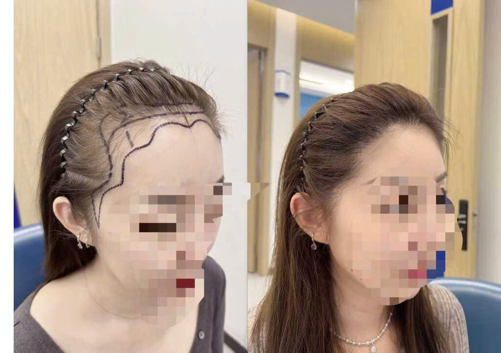 Bác sĩ và bệnh nhân tư vấn cấy tóc tự thân Nghệ An tại phòng khám EMCA, quy trình hiện đại và môi trường phòng khám sạch sẽ