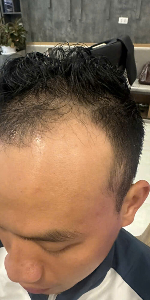 Bác sĩ thực hiện cấy tóc Vinh tại phòng khám EMCA, quy trình FUE an toàn