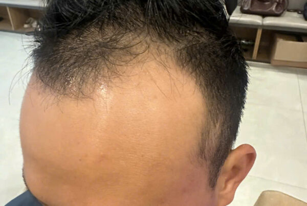 Bác sĩ thực hiện cấy tóc Vinh tại phòng khám EMCA, quy trình FUE an toàn