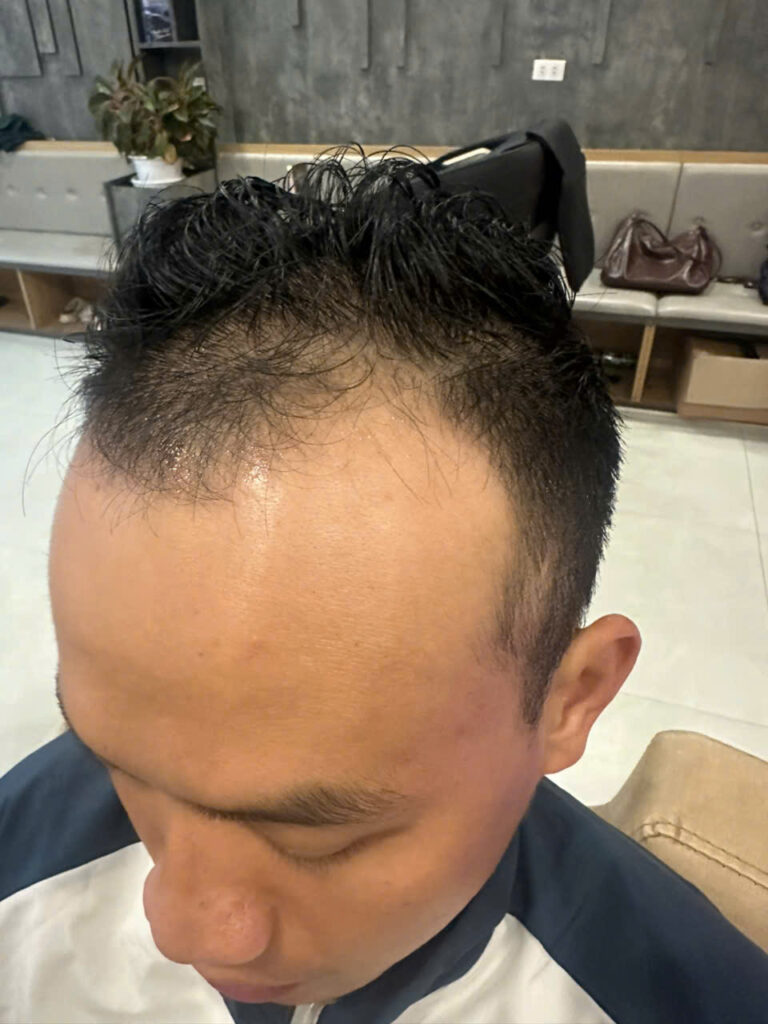 Bác sĩ thực hiện cấy tóc Vinh tại phòng khám EMCA, quy trình FUE an toàn