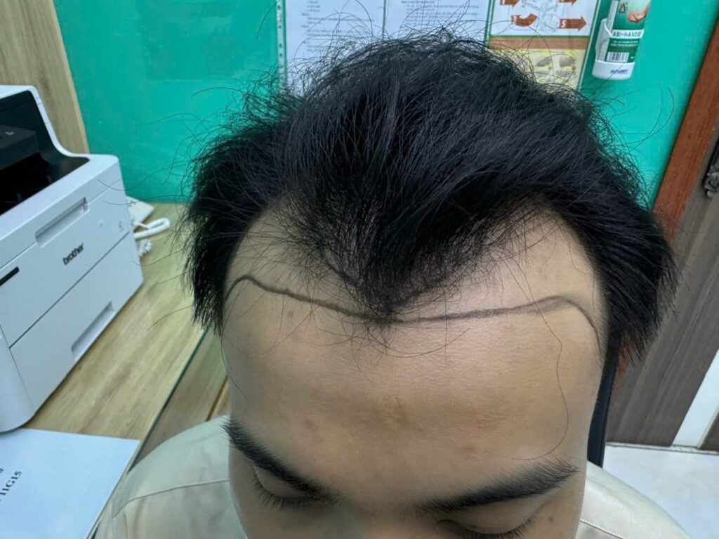 Bác sĩ khám và tư vấn điều trị rụng tóc Nghệ An tại phòng khám EMCA, TP. Vinh