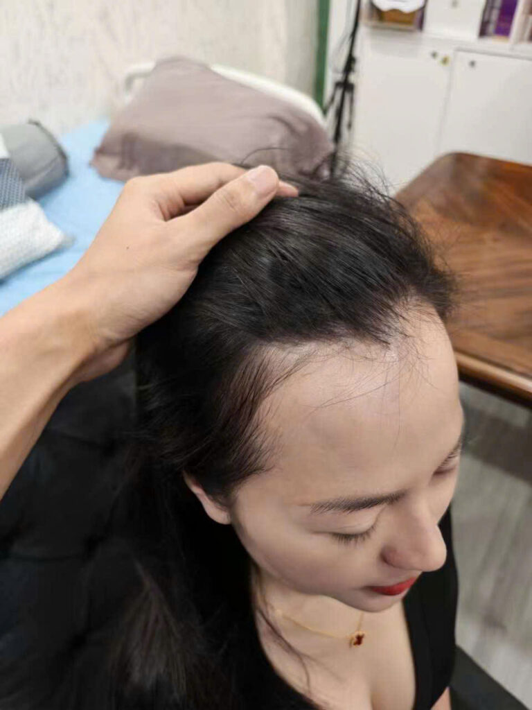 Bác sĩ khám và tư vấn trị rụng tóc Nghệ An tại phòng khám EMCA ở TP Vinh